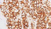 technology Yksilöllinen hoito Microarray test for drug response