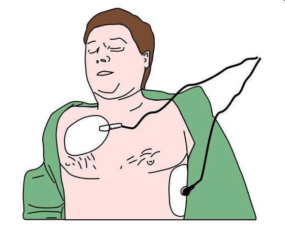 67 Defibrillaatio Elektrodien oikea sijoittelu: - Oikean solisluun alapuolelle (muista varoa tahdistinta) - Vasen kylki n.
