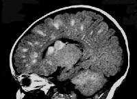 edeltävät neurologiset oireet (koreoatetoosi ja dystonia) Diagnoosi mahdollinen myös potilailla, joilla on varhain alkanut lievempi epilepsia ja myöhemmin aterioita edeltäviä tajunnanhäiriöitä