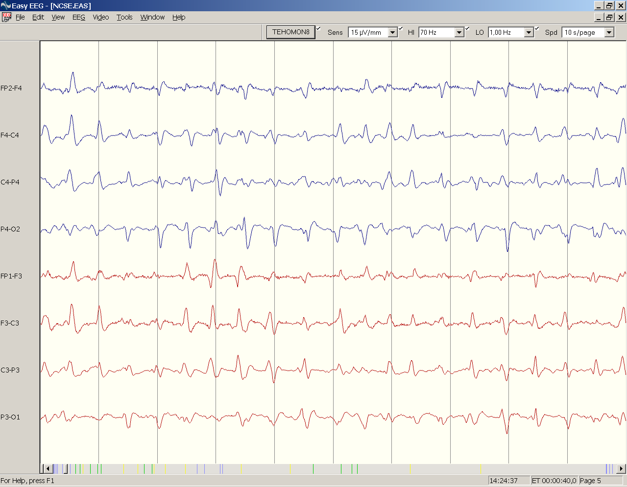 Nonkonvulsiiviset status epilepticukset Absence- ja tajunnanhämärtymisoireisen SE:n erotusdiagnostiikka on kliinisesti vaikeaa ilman EEG:tä, jos perussairaus/epilepsian tyyppi ei ole tiedossa.