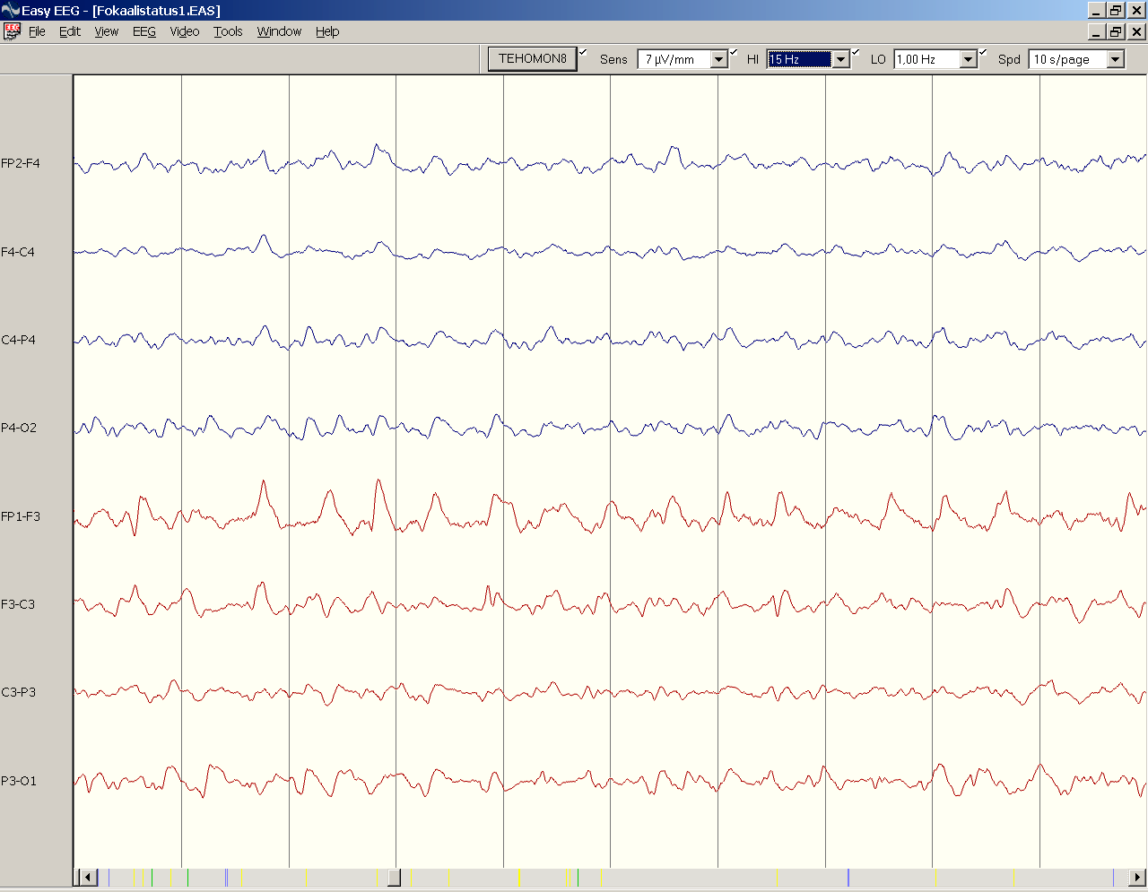Paikallinen, rajautuva status epilepticus Esim. jatkuva klooninen käden nykinä ilman tajunnan hämärtymistä. Sähköinen häiriö rajoittuu paikalliselle (pienelle) alueelle.