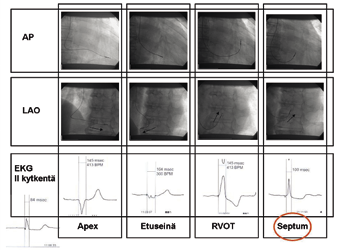 Erityisesti on huomioitava, että LAO-suunnassa johdon kärki voi osoittaa septumin suuntaan, mutta sijaita kuitenkin ei-toivotussa kohdassa oikean kammion etuseinässä lähellä liitoskohtaa vasempaan