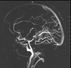 psykologiaan http://www.tsv.fi/ttapaht/986/sisalto.html 23.10.2005) Verisuonet näkyvät magneettikivassa, koska magneettikuvaus pystyy havaitsemaan veren virtauksen.