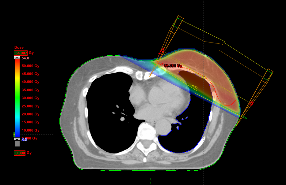 Kuva 9. Vasemman rinnan sädehoito. Potilaan tilavuuksien määritys TT-pakan ulkopuolisen kehon alueen tilavuus V ei-tt määritettiin potilaan massan ja ominaispainon avulla.