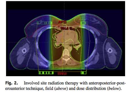 Involved site radiation therapy Huomioidaan prim tuumori ja