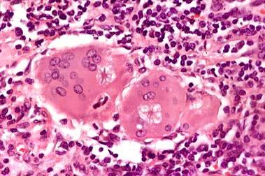 PAD: INFLAMMATIO GRANULOMATOSA (KEUHKO) Yleinen histologinen