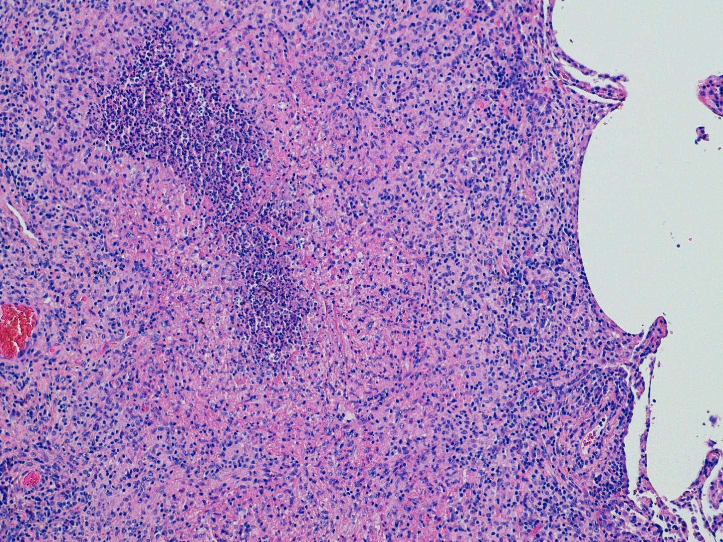 Yleinen histologinen diagnoosi patologi etiologisen haasteen edessä - PDF  Free Download