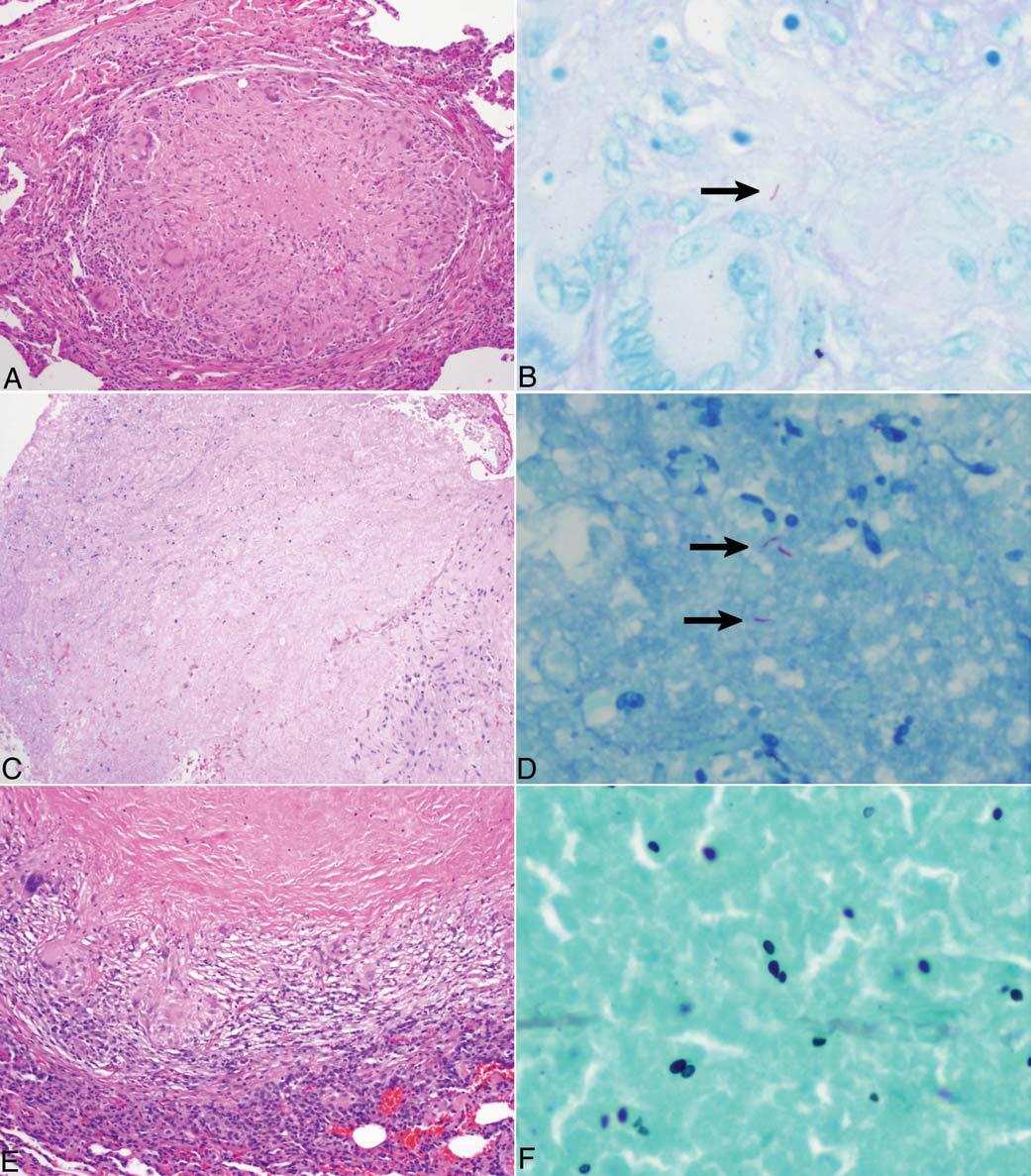 A-D MYCOBACTERS E-F HISTOPLASMA ARCH