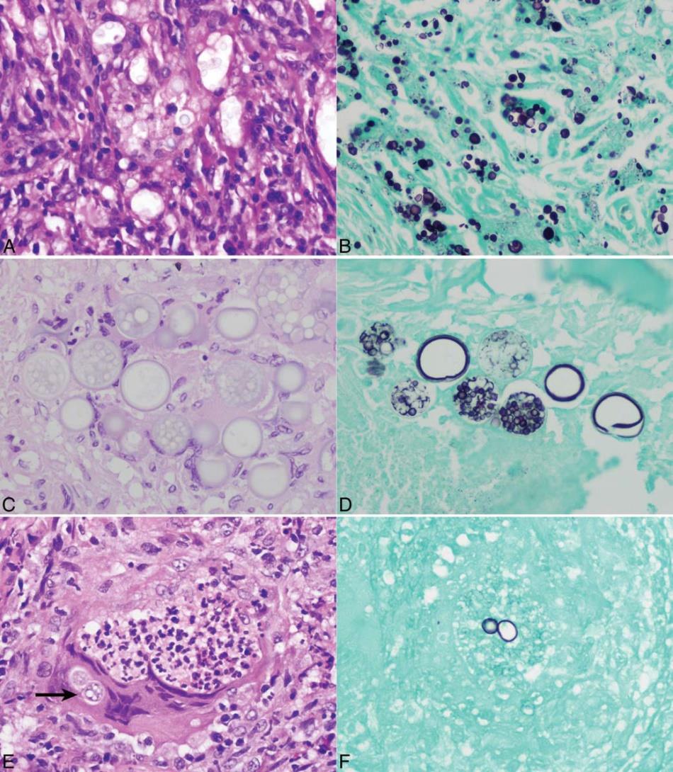 SIENET Cryptococcus AB Coccidioides CD