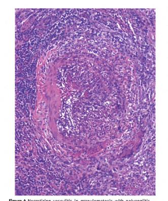 VASKULIITIT Granulomatosis et polyangitis, Wegener granulomatosis