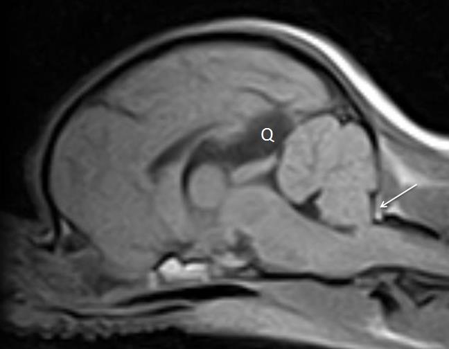 2.7.2 Muut kuvantamisen menetelmät Magneettikuvauksen lisäksi muita kuvantamisen menetelmiä on myös pyritty soveltamaan Chiari-tyyppisen epämuodostuman ja syringomyelian diagnosoimiseksi.