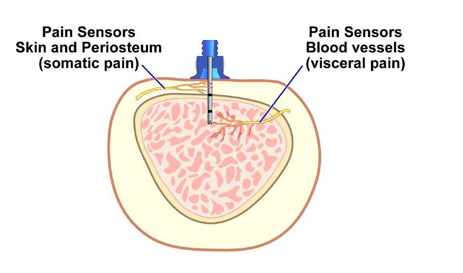 Kivun anatomia Somaattinen kipu