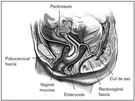 Vaginaprolapsi ja enterocele
