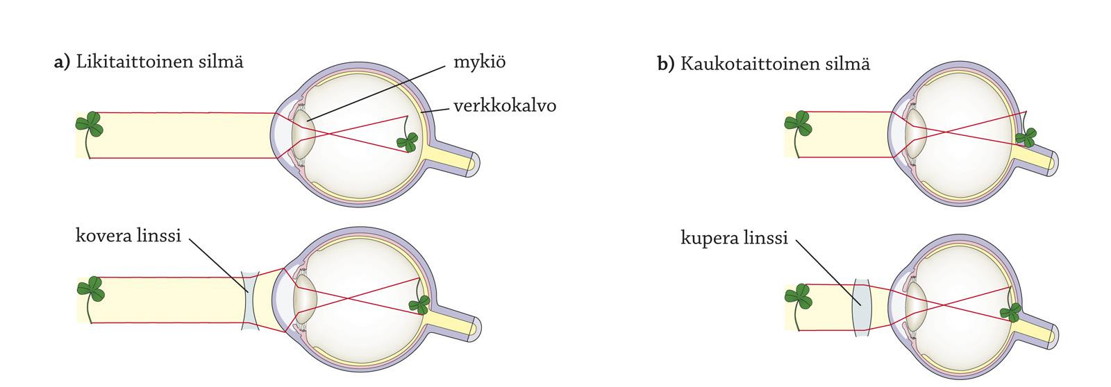 Taittovirheet Nuoruusiän likitaitteisuus (myopia) johtuu yleensä liian pitkästä silmämunasta.