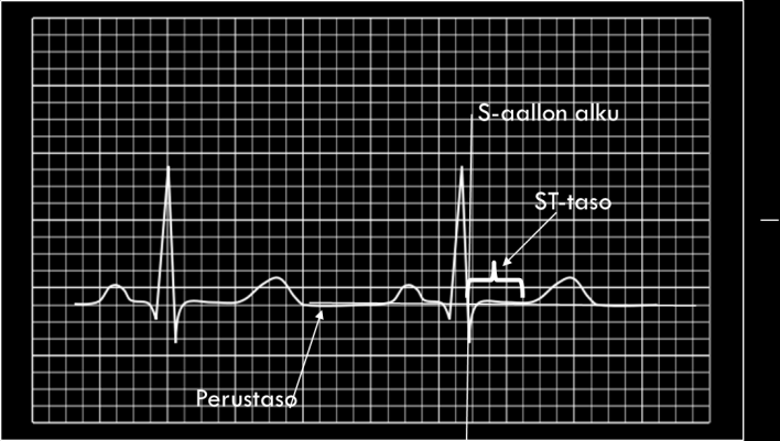 SYDÄNINFARKTI EKG:tä tulkittaessa ST-taso muutokset voivat viittata sydän infarktiin, jos: kahden samaa aluetta katsovan raajakytkennän ST-tason nousu on =/enemmän kuin 1 mm.