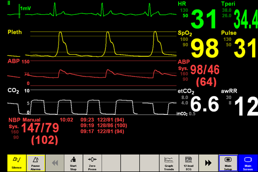 Sinus bradykardia