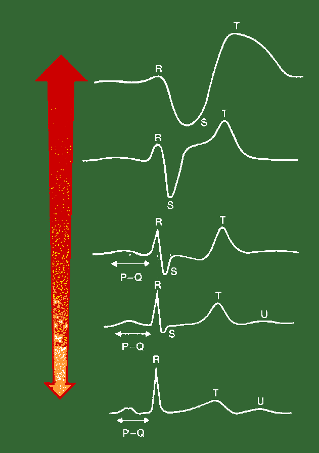 Hyperkalemia Piikkimäiset T-aallot S-K (mmol/l) = 6,8