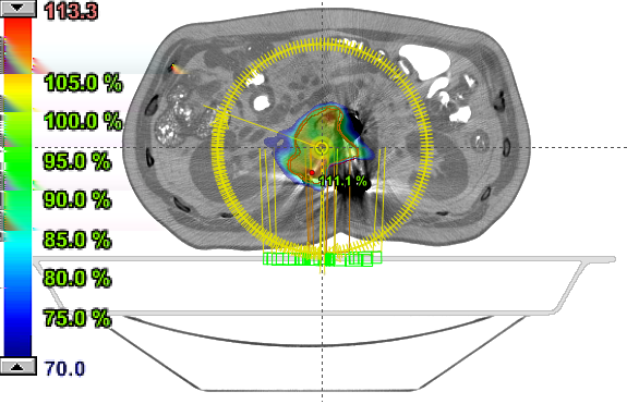 (a) SBRT prostatasuunnitelma. (b) SRT aivosuunnitelma. (c) SBRT keuhkosuunnitelma. (d) SBRT vartalon alueen suunnitelma. Kuva 6.
