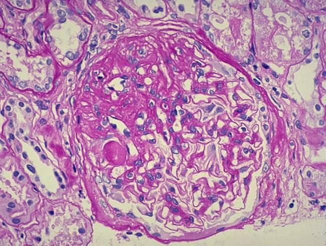 Jalkalisäkkeiden tuhoutuminen Normaali Diffuusi podosyyttivaurio Minimal change disease Minimal change disease