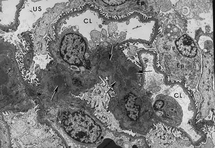 Nefroottinen syndroma: voimakas proteinuria (>3,5 g/vrk), hypoalbuminemia, voimakas ödema, hyperlipidemia, lipiduria Akuutti nefriittinen syndroma: hematuria, lievä tai kohtalainen proteinuria,