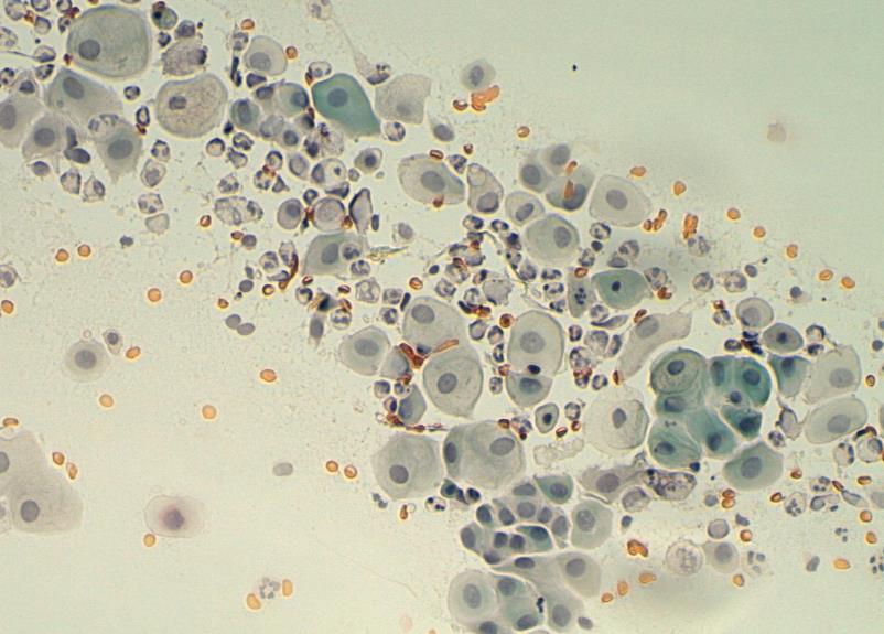 15 3.1.2 Metaplastinen epiteeli Kohdunsuun levy- ja lieriöepiteelin junktiossa on muuntumisalue, jossa lieriöepiteeli muuttuu levyepiteeliksi (solun metaplasia).