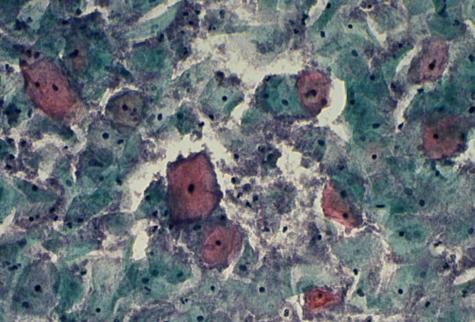 17 3.1.6 Bakteerifloora Vaginassa vallitsee monia erilaisia bakteereja. Normaali bakteerifloora jaetaan kuitenkin sen mukaan, onko vallitsevana bakteerina sauvabakteeri (kuva 4.1.6 A) vai kokkisekaflooraa (kuva 4.