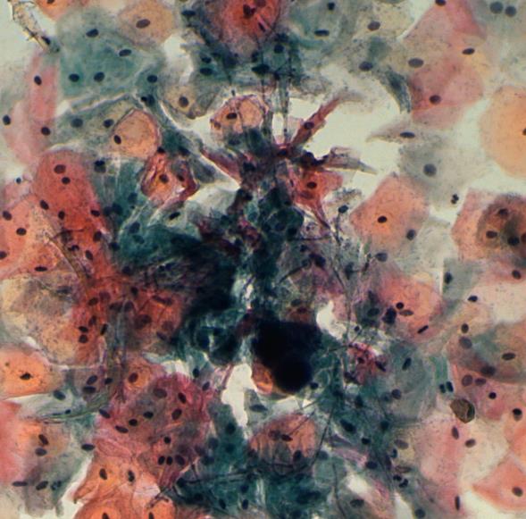 22 kuin Actinomyces, eli sädesieni. Se on gram- positiivinen anaerobinen bakteeri, joka näyttää mikroskoopissa tummalta, rihmamaiselta ja monihaaraiselta. (Purola 1994: 50.