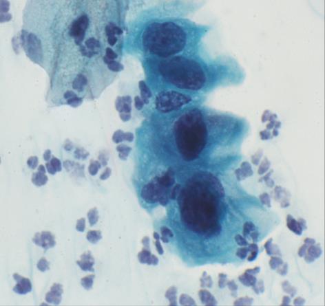 30 Kuvio 3.5.4 HSIL-tason solumuutosta. (Dehqanzada 2012b). HSIL luokkaan kuuluvat solut (kuva 3.5.4) ovat usein sijoittuneet näytteessä yleensä yksittäin, levyihin tai ne ovat aggrigoituneena.
