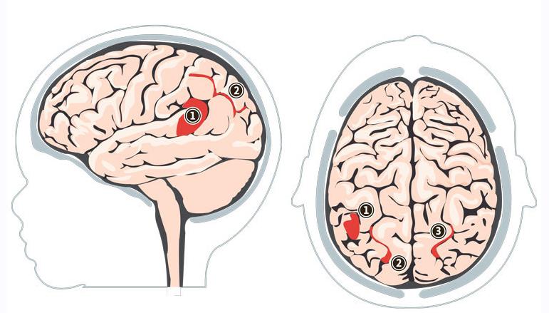 Neurobiological päälakilohkon alue 1. The left angular gyrus (AG) 2 + 3 2.