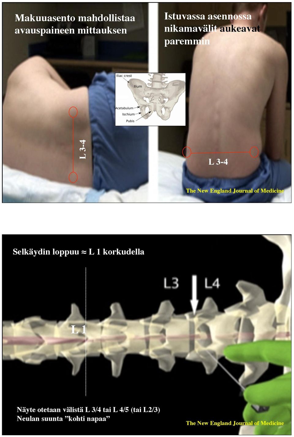 Medicine Selkäydin loppuu L 1 korkudella L 1 Näyte otetaan välistä L 3/4