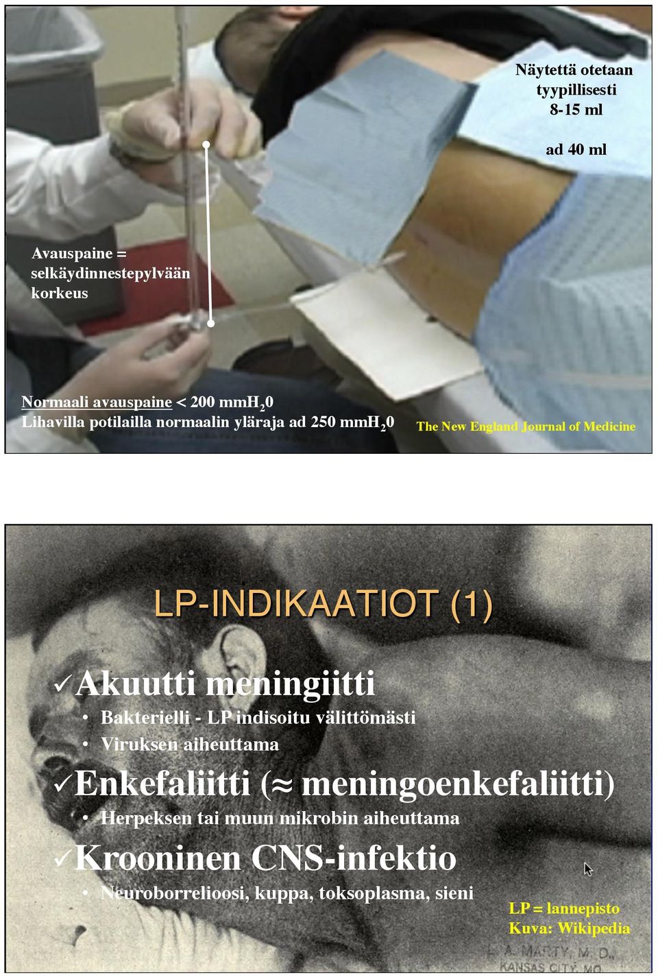 meningiitti Bakterielli - LP indisoitu välittömästi Viruksen aiheuttama ü Enkefaliitti ( meningoenkefaliitti) Herpeksen