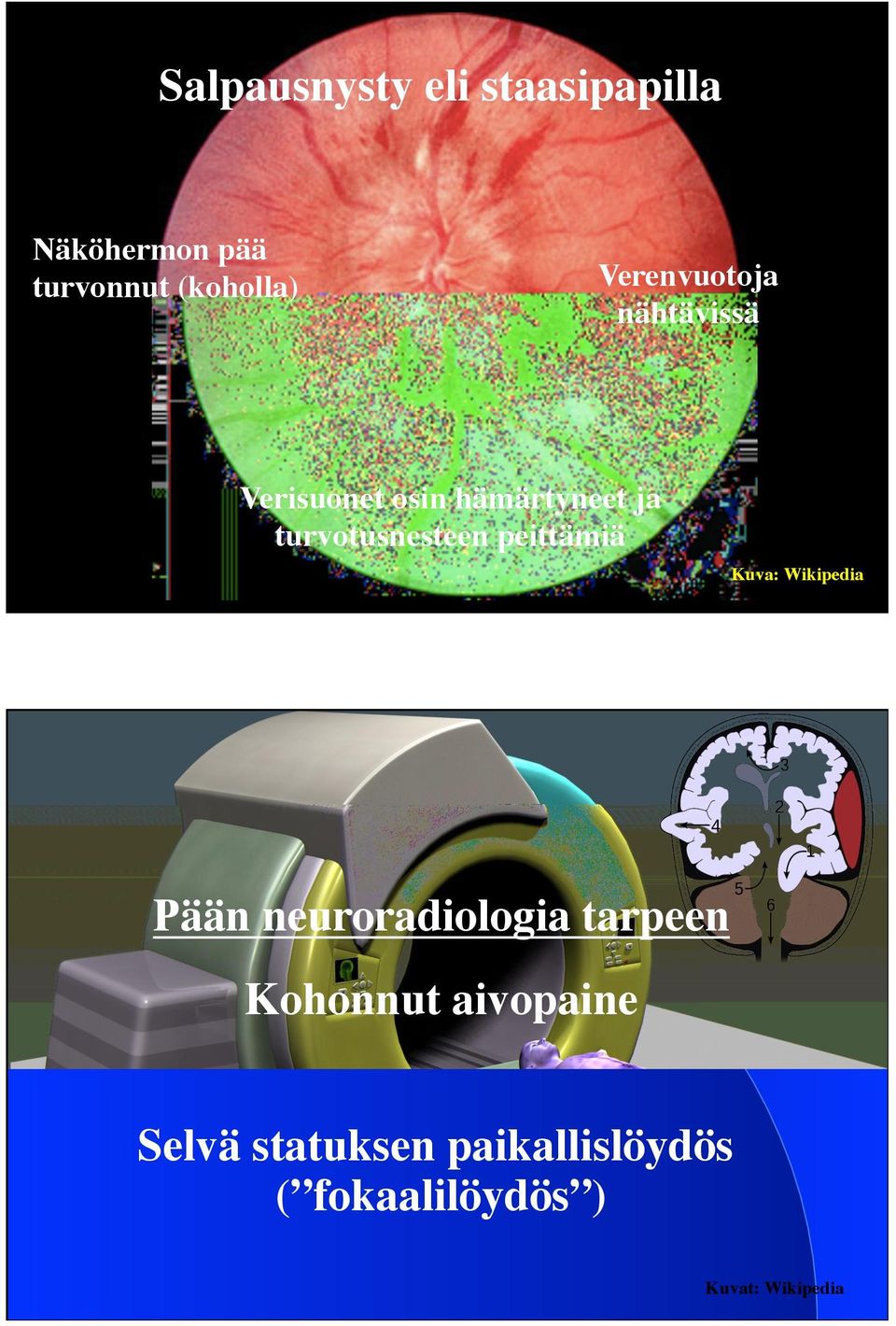 turvotusnesteen peittämiä Kuva: Wikipedia Pään neuroradiologia