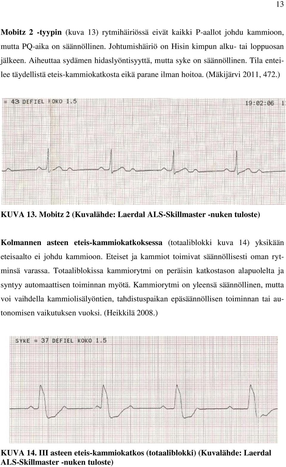 Mobitz 2 (Kuvalähde: Laerdal ALS-Skillmaster -nuken tuloste) Kolmannen asteen eteis-kammiokatkoksessa (totaaliblokki kuva 14) yksikään eteisaalto ei johdu kammioon.