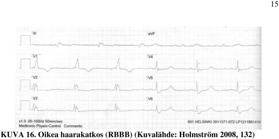 (RBBB)