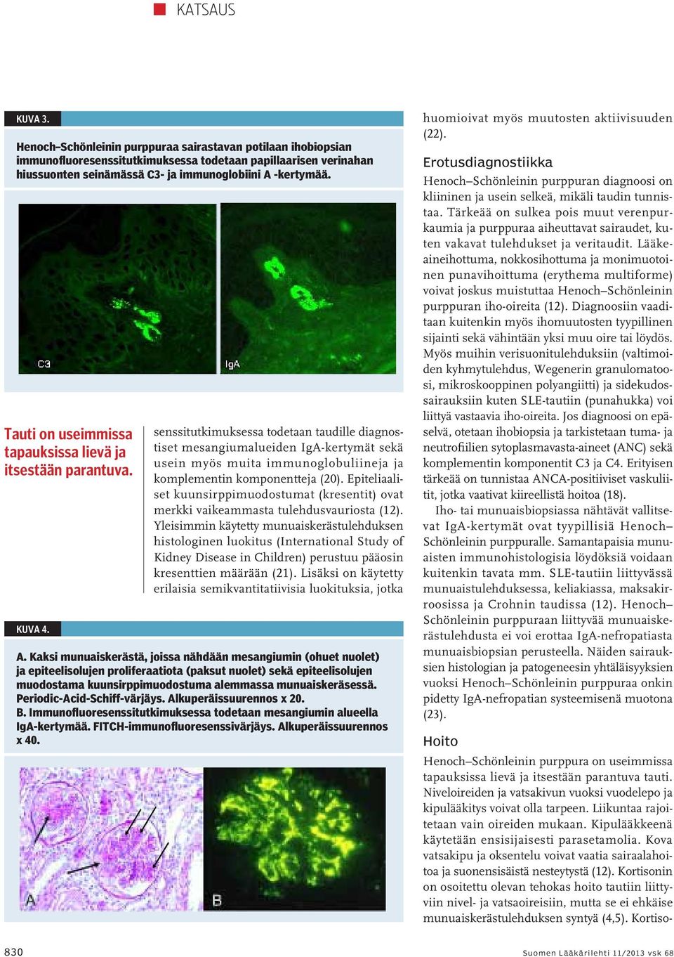 senssitutkimuksessa todetaan taudille diagnostiset mesangiumalueiden IgA-kertymät sekä usein myös muita immunoglobuliineja ja komplementin komponentteja (20).