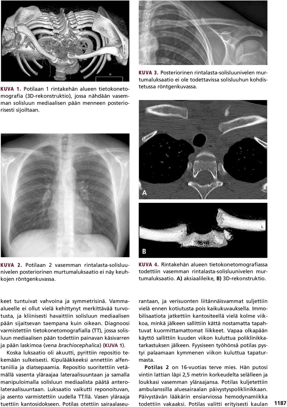 Potilaan 2 vasemman rintalasta-solisluunivelen posteriorinen murtumaluksaatio ei näy keuhkojen röntgenkuvassa. KUVA 4.