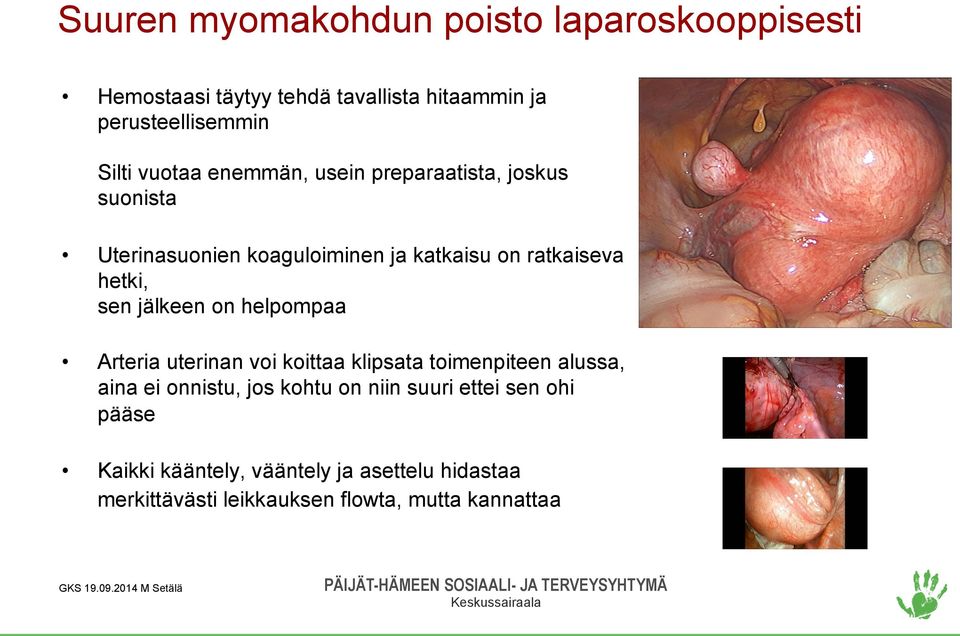 jälkeen on helpompaa Arteria uterinan voi koittaa klipsata toimenpiteen alussa, aina ei onnistu, jos kohtu on niin