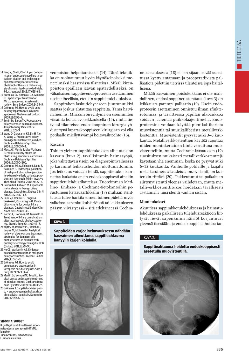 J Gastroenterol 2012;47:655 63. 15 Antoniou SA, Antoniou GA, Makridis C. Laparoscopic treatment of Mirizzi syndrome: a systematic review. Surg Endosc 2010;24:33 9. 16 Grönroos JM.