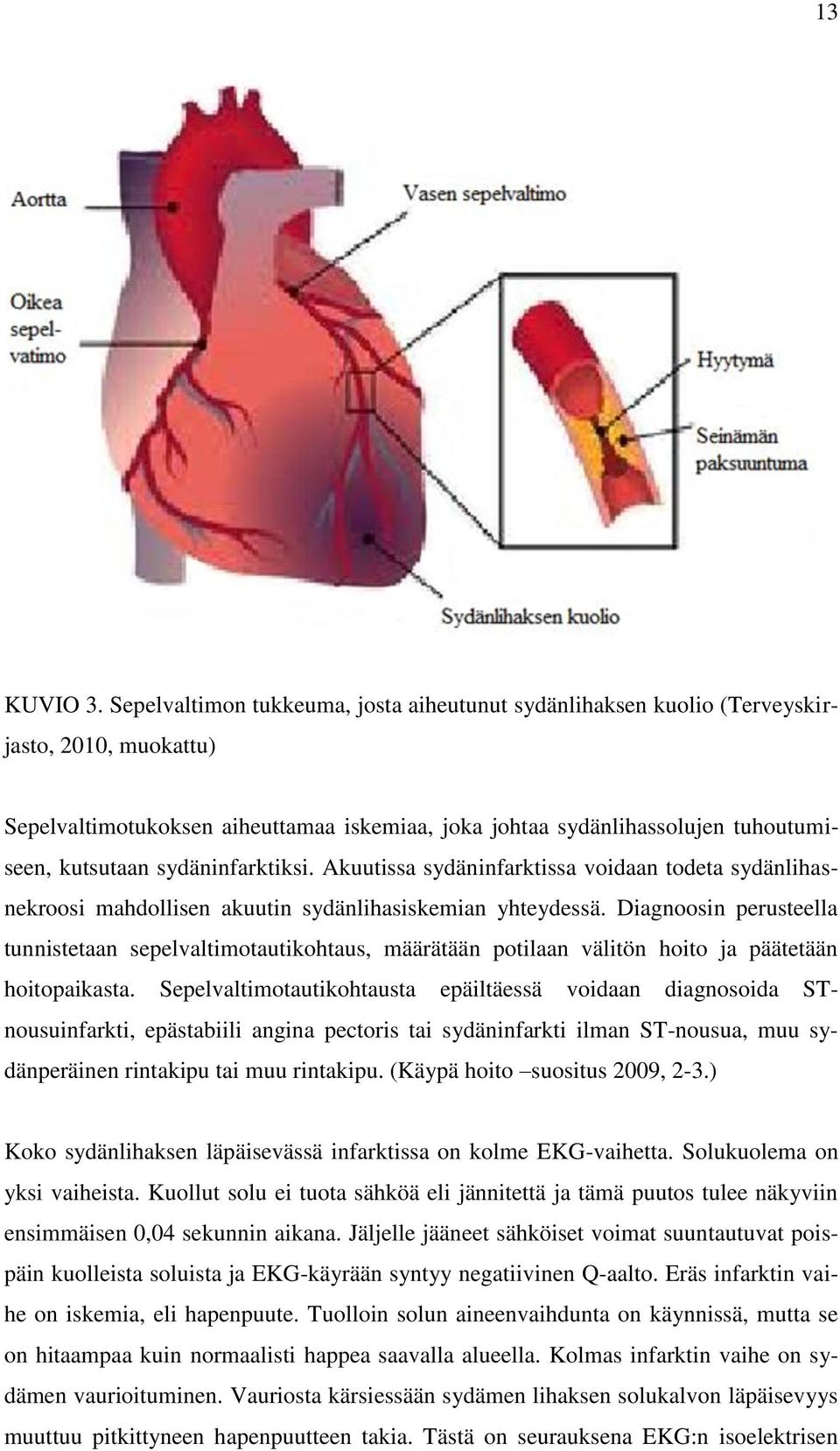 sydäninfarktiksi. Akuutissa sydäninfarktissa voidaan todeta sydänlihasnekroosi mahdollisen akuutin sydänlihasiskemian yhteydessä.