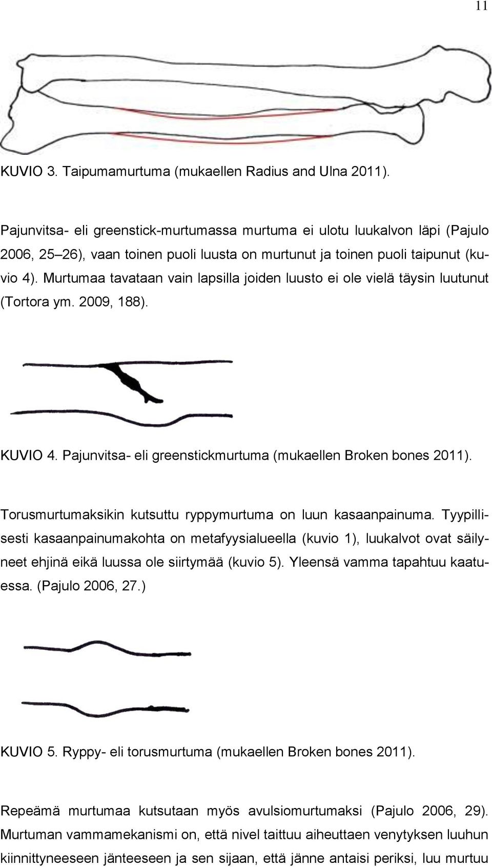 Murtumaa tavataan vain lapsilla joiden luusto ei ole vielä täysin luutunut (Tortora ym. 2009, 188). KUVIO 4. Pajunvitsa- eli greenstickmurtuma (mukaellen Broken bones 2011).