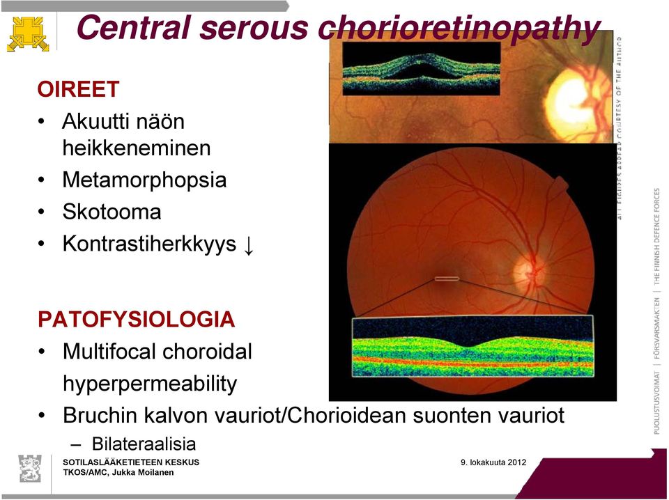 Kontrastiherkkyys PATOFYSIOLOGIA Multifocal choroidal