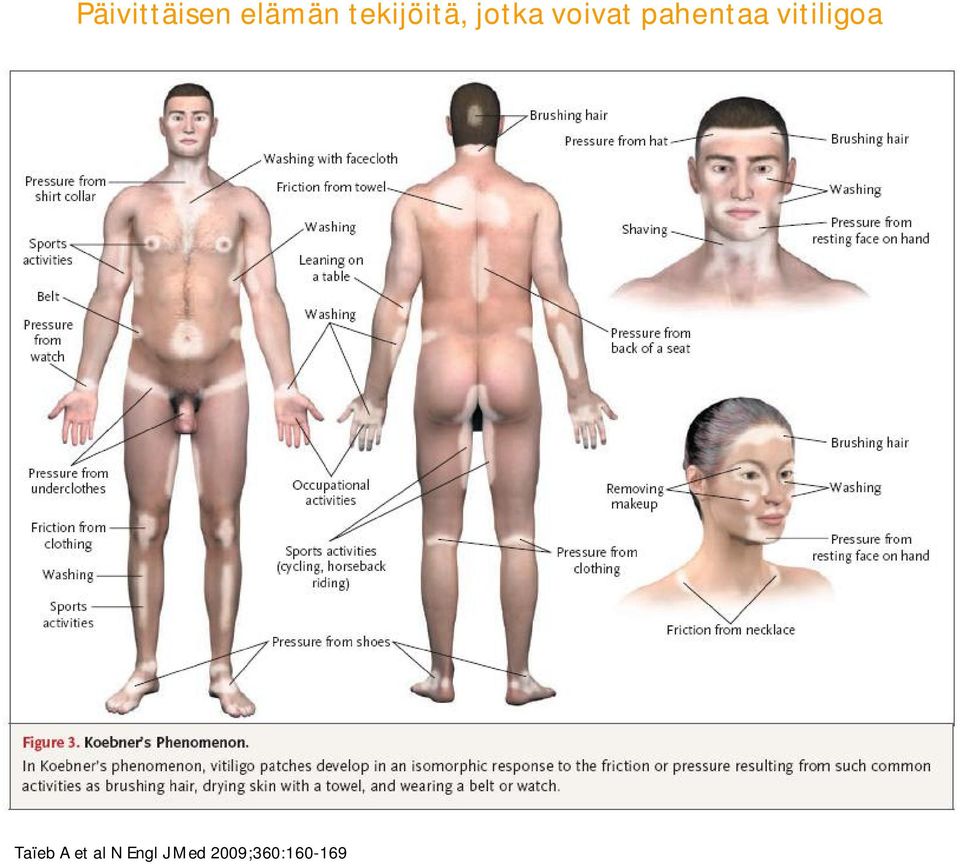 pahentaa vitiligoa Taïeb A