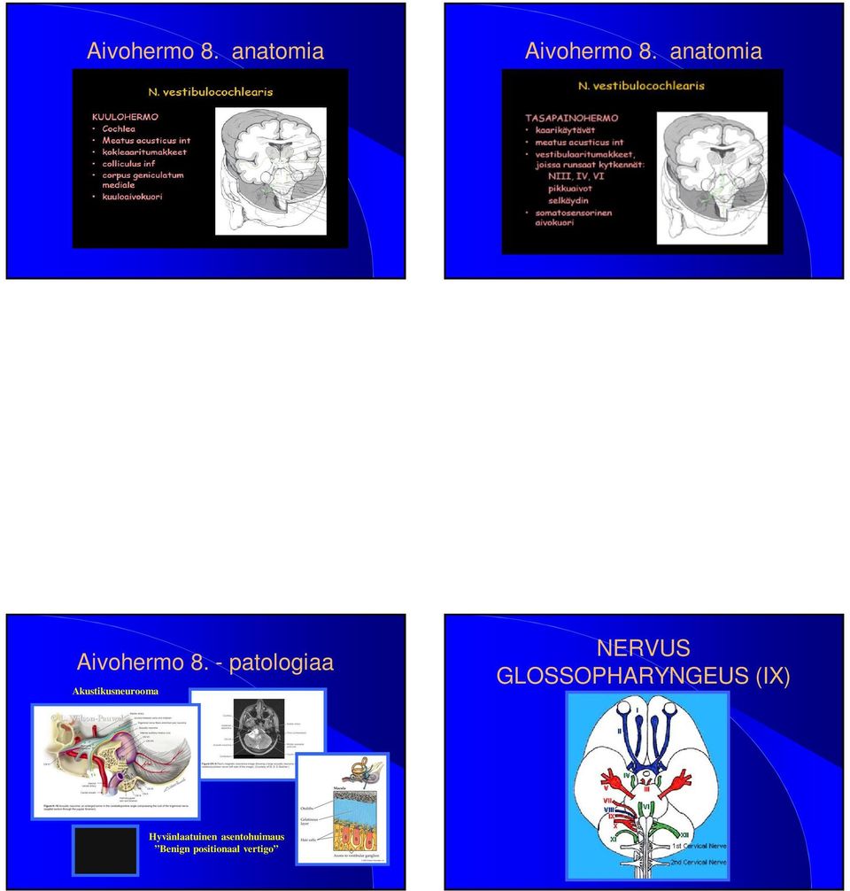 - patologiaa Akustikusneurooma NERVUS