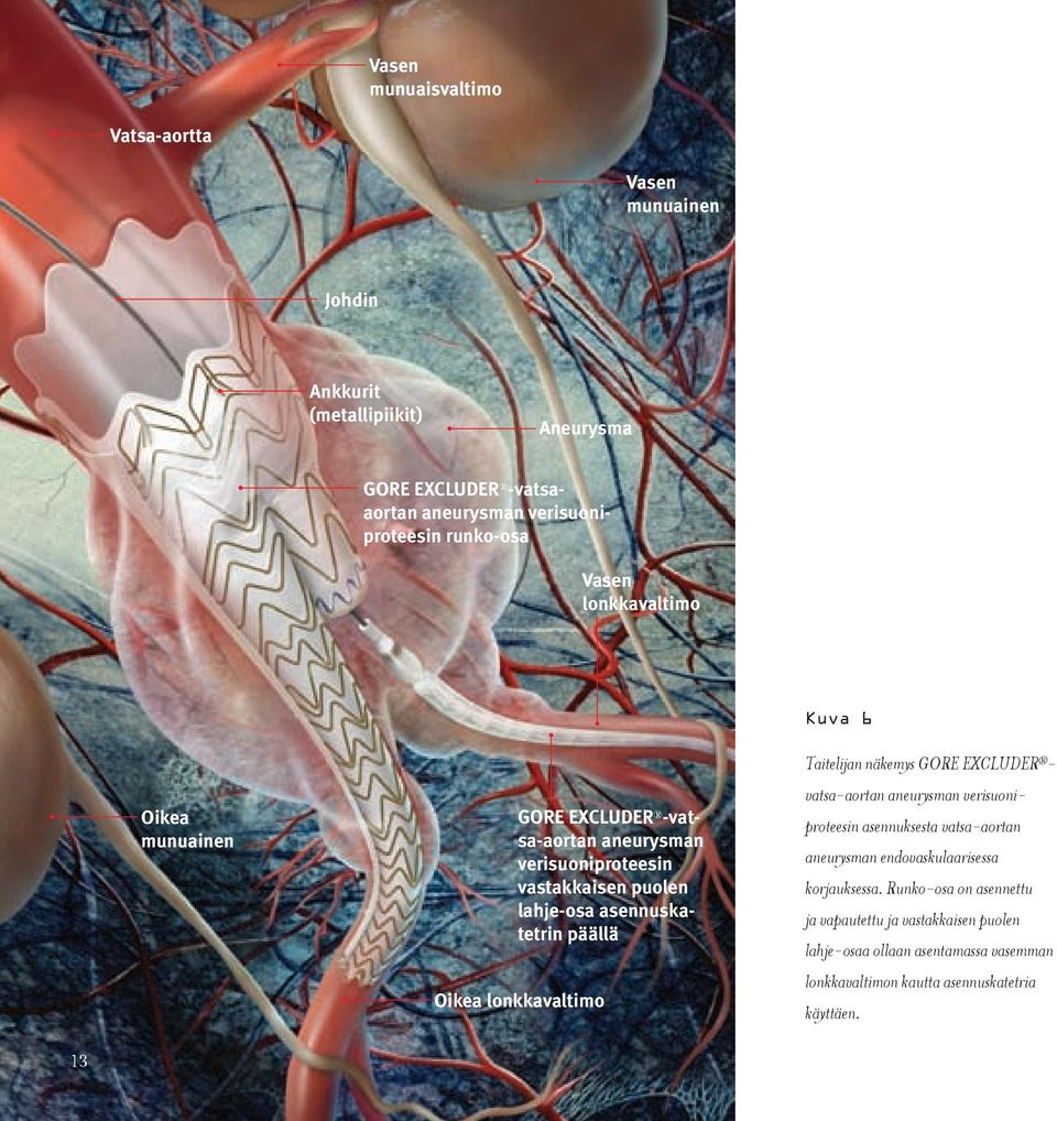 Oikea lonkkavaltimo Kuva 6 Taitelijan näkemys GORE EXCLUDER - vatsa-aortan aneurysman verisuoniproteesin asennuksesta vatsa- aortan aneurysman