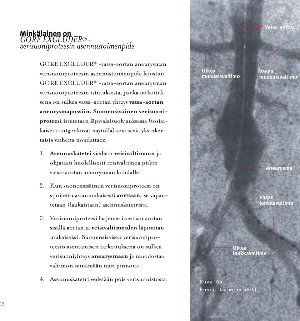 Suonensisäinen verisuoniproteesi istutetaan läpivalaisuohjauksessa (tosiaikaiset röntgenkuvat näytöllä) seuraavia yksinkertaisia vaiheita noudattaen: 1.