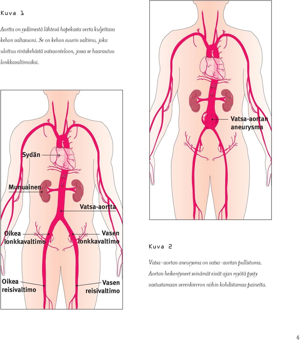 Vatsa-aortan aneurysma Sydän Munuainen Vatsa-aortta Oikea lonkkavaltimo Oikea reisivaltimo Vasen lonkkavaltimo Vasen