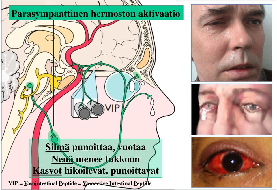 Kasvot hikoilevat, punoittavat VIP =