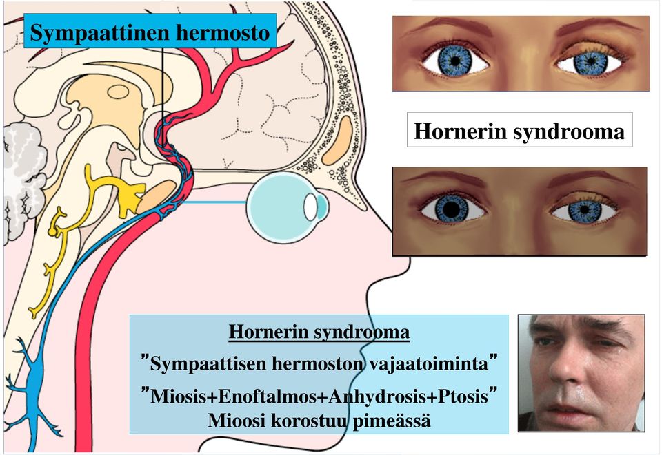 Sympaattisen hermoston vajaatoiminta