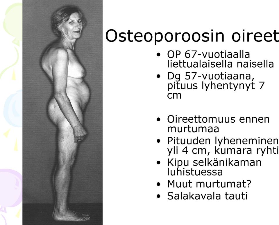 Oireettomuus ennen murtumaa Pituuden lyheneminen yli 4 cm,