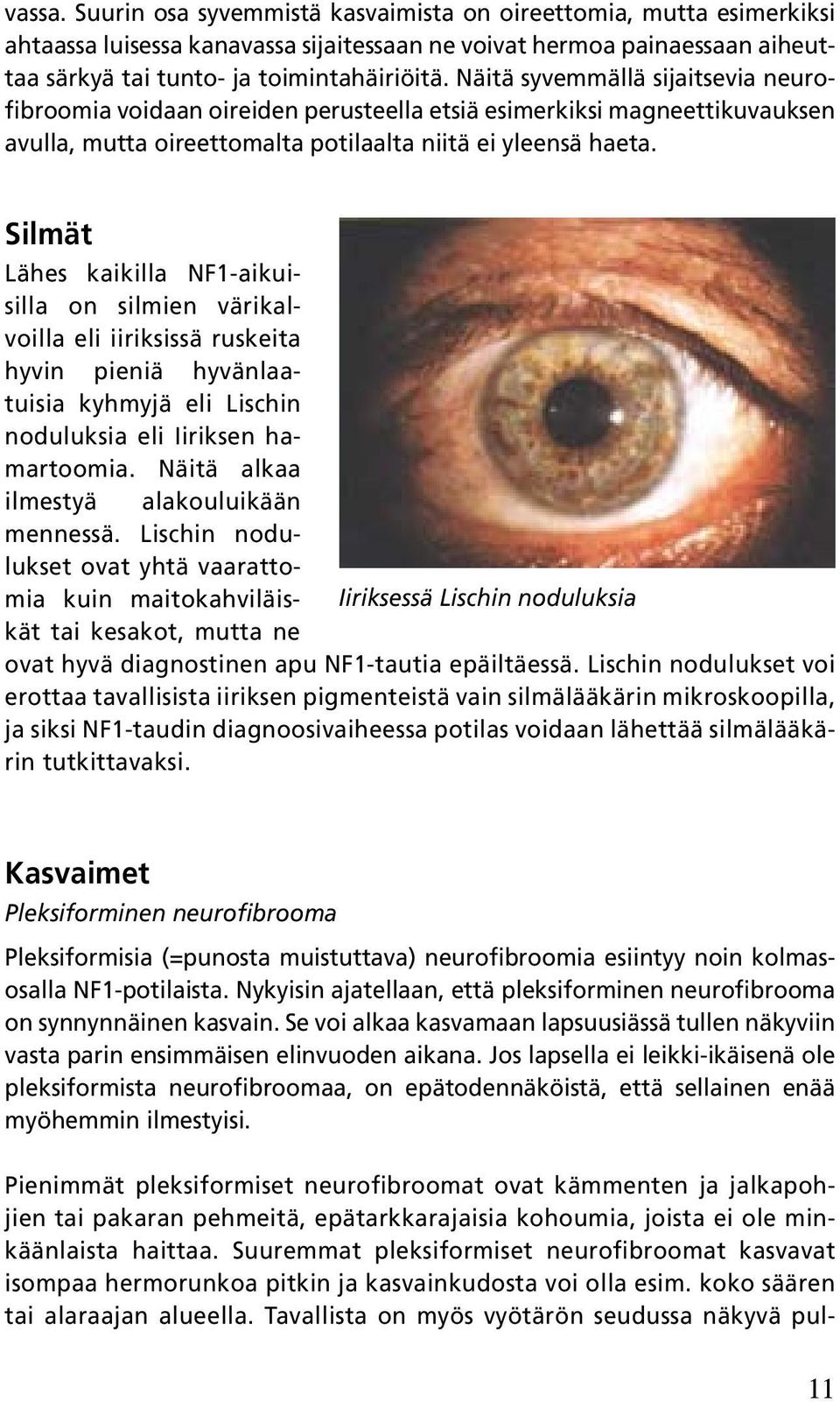 Silmät Lähes kaikilla NF1-aikuisilla on silmien värikalvoilla eli iiriksissä ruskeita hyvin pieniä hyvänlaatuisia kyhmyjä eli Lischin noduluksia eli Iiriksen hamartoomia.